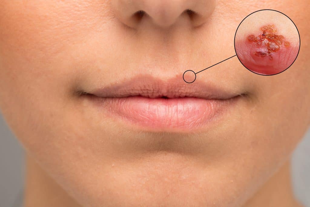 Herpes na usni - uzrok i liječenje