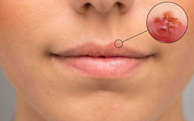 Herpes na usni – uzrok i liječenje