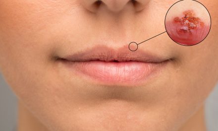Herpes na usni – uzrok i liječenje