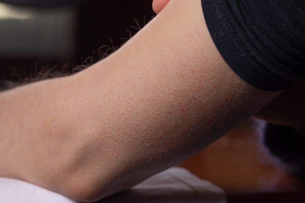 Keratosis pilaris ili pureća koža - uzrok, simptomi i liječenje