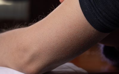 Keratosis pilaris ili pureća koža – uzrok, simptomi i liječenje