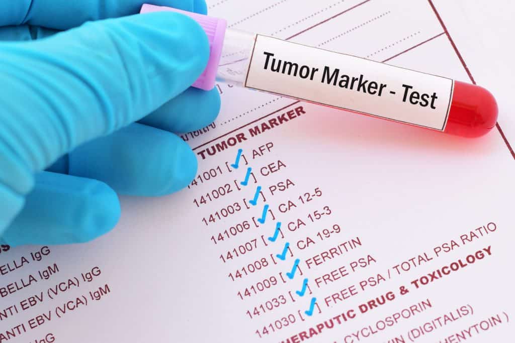 Tumorski markeri - što su i kako se rade