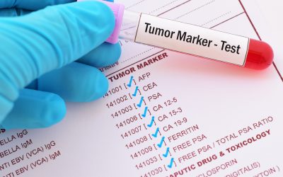 Tumorski markeri – što su i kako se rade