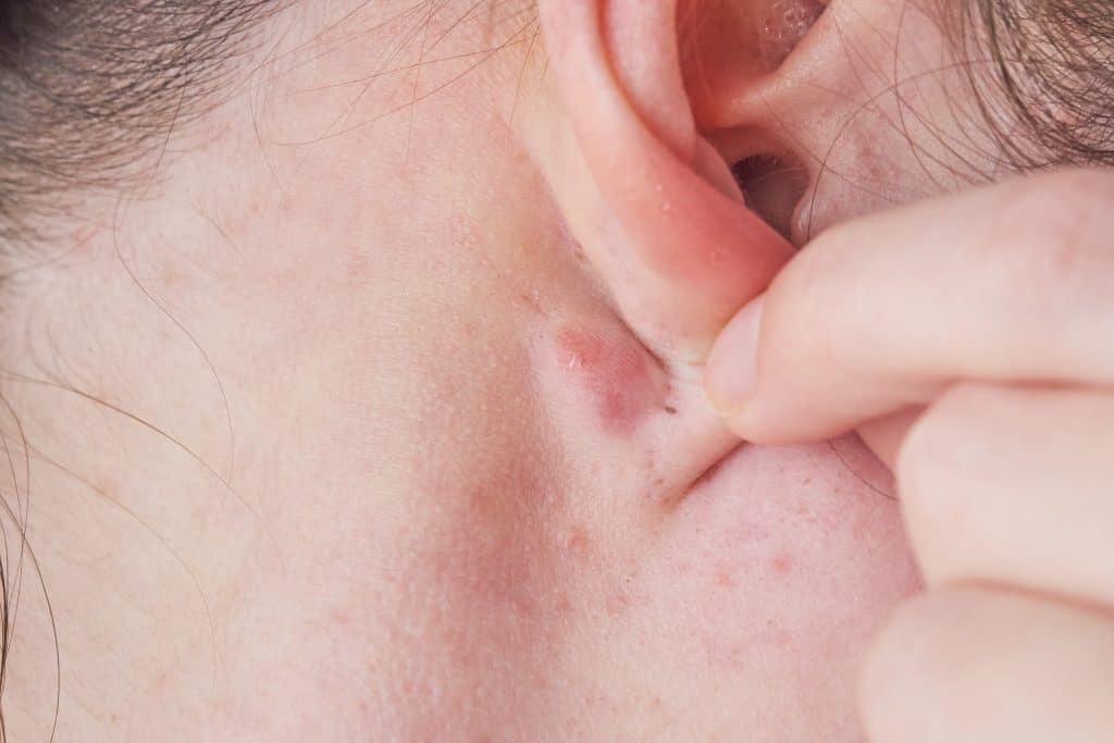 Kvržica iza uha - uzrok i liječenje