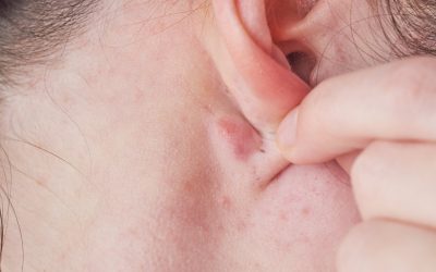 Kvržica iza uha – uzrok i liječenje