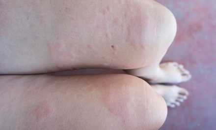 Lichen planus – uzrok, simptomi i liječenje