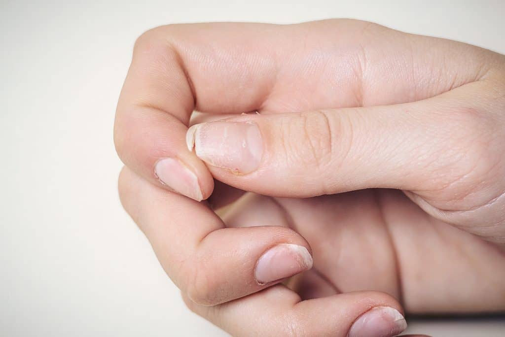 Lomljivi nokti - uzrok i liječenje