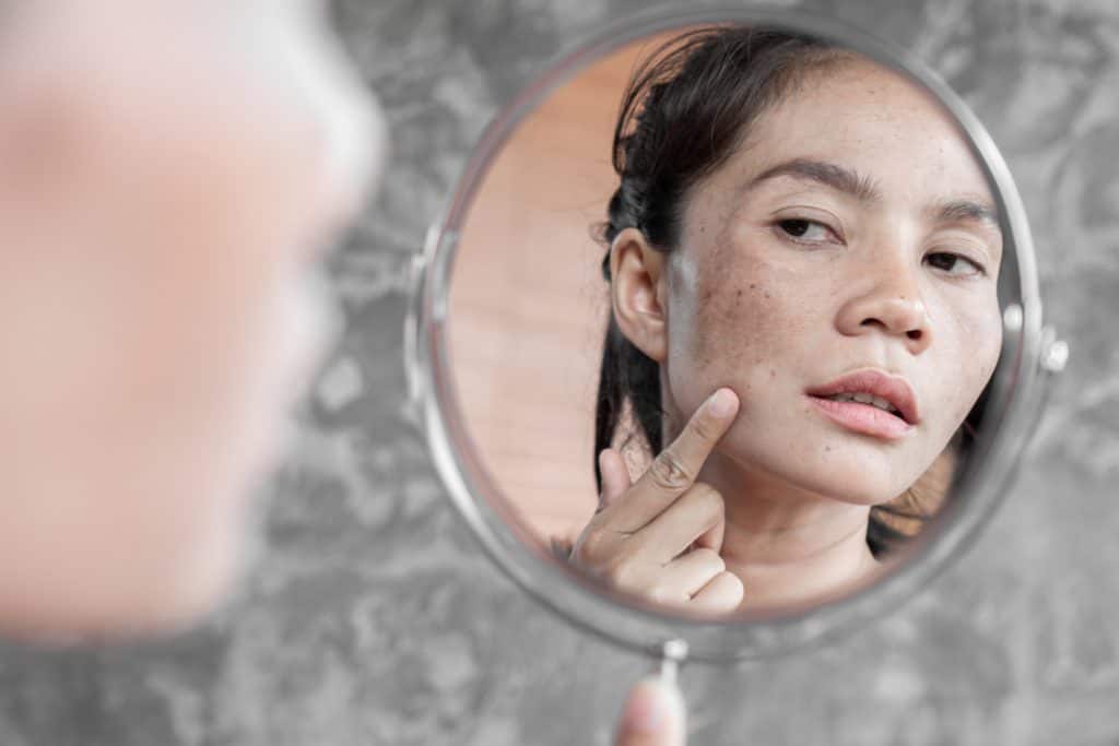 Melasma (hiperpigmentacija lica) – uzrok, simptomi i liječenje