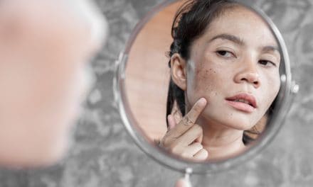 Melasma (hiperpigmentacija lica) – uzrok, simptomi i liječenje