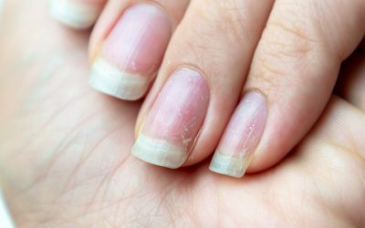 Mrlje na noktu – uzrok i liječenje