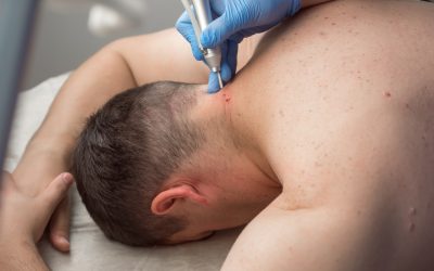 Papilomi na vratu – uzrok, simptomi, liječenje