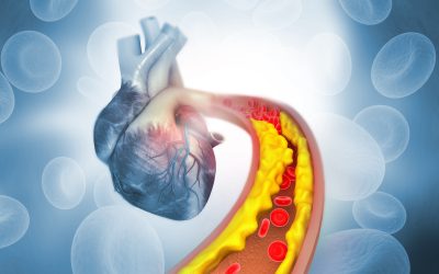 Povišen kolesterol u krvi – uzrok, simptomi i liječenje