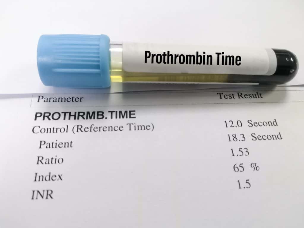 Protrombinsko vrijeme - što je i kako se izvodi test