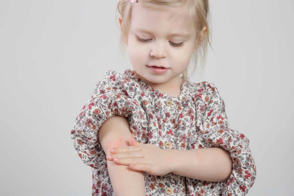 Psorijaza kod djece - uzrok, sipmtomi, liječenje