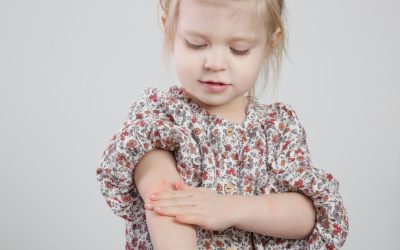 Psorijaza kod djece – uzrok, sipmtomi, liječenje