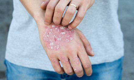 Psorijaza kože – uzrok, sipmtomi, liječenje