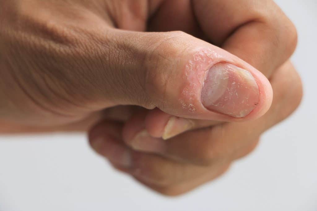 Psorijaza nokta - uzrok, sipmtomi, liječenje