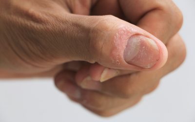 Psorijaza nokta – uzrok, sipmtomi, liječenje