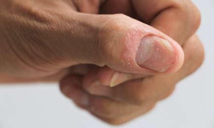 Psorijaza nokta – uzrok, sipmtomi, liječenje