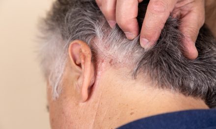 Psorijaza vlasišta – uzrok, sipmtomi, liječenje