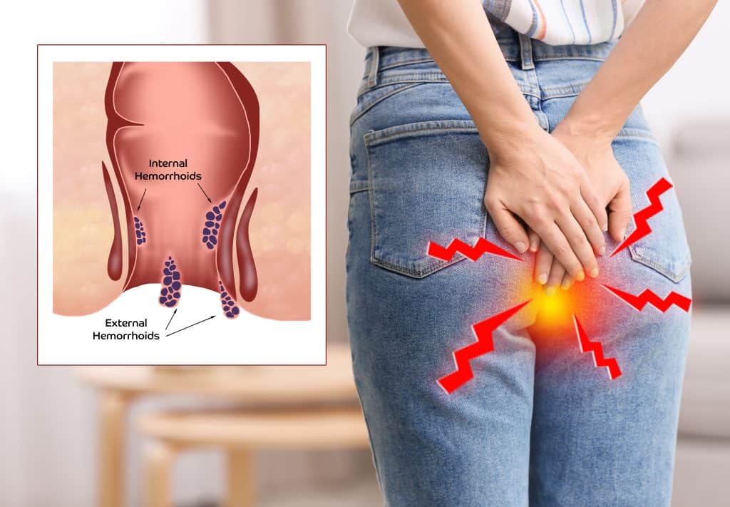 Pucanje hemoroida - uzrok, simptomi i liječenje
