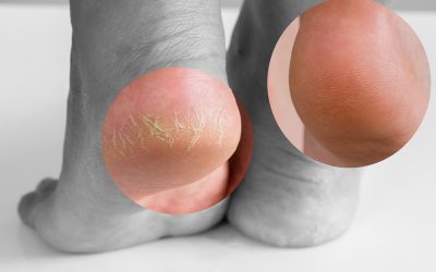 Puknuta peta na nozi – uzrok i liječenje