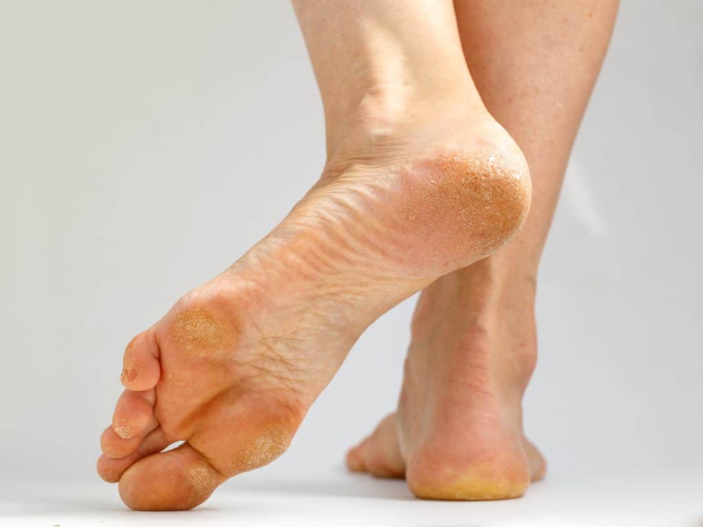 Zadebljanje na stopalu - uzrok i liječenje