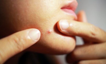 Akne na prstima – uzrok, simptomi, liječenje
