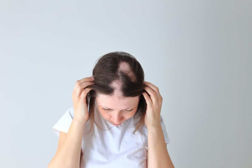 Alopecija areata - uzrok, simptomi i liječenje