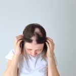 Alopecija areata – uzrok, simptomi i liječenje