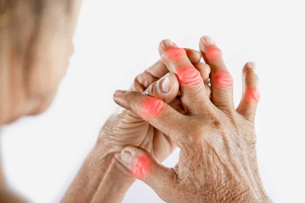 Artritis prstiju - uzrok, simptomi i liječenje