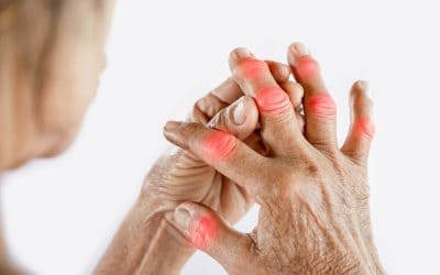 Artritis prstiju – uzrok, simptomi i liječenje