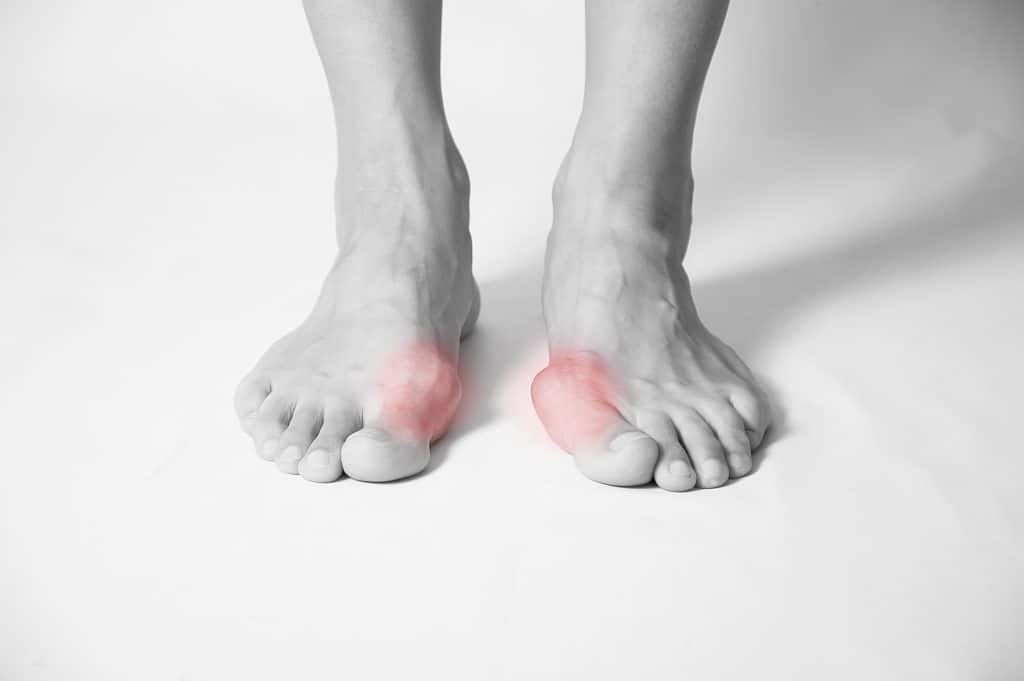 Deformacija palca na stopalu - uzrok, simptomi, liječenje