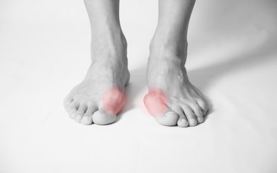 Deformacija palca na stopalu – uzrok, simptomi, liječenje