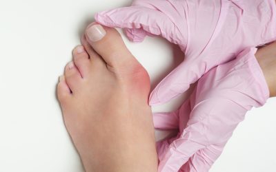 Deformacije stopala – uzrok, simptomi, liječenje