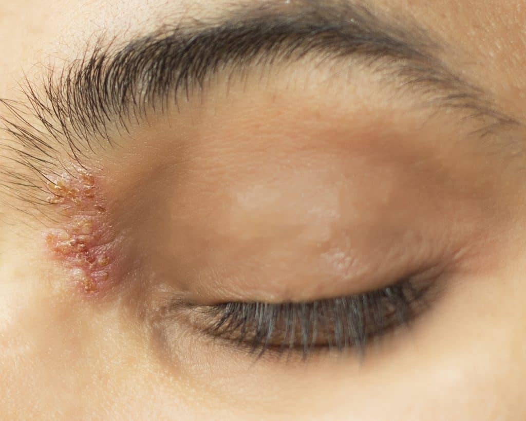 Herpes na oku - uzrok, simptomi i liječenje