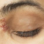 Herpes na oku – uzrok, simptomi i liječenje