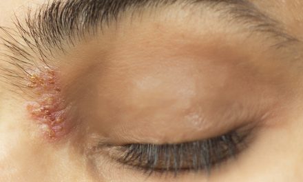Herpes na oku – uzrok, simptomi i liječenje
