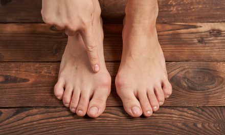 Izbočena kost na stopalu – uzrok, simptomi, liječenje