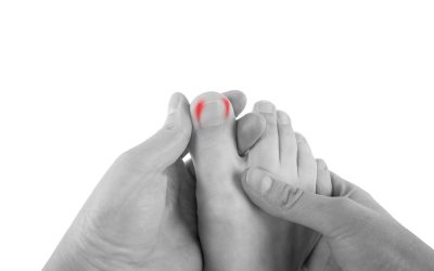 Mikoza noktiju – uzrok, simptomi, liječenje