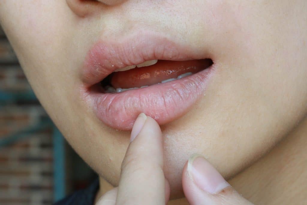Suha usta (kserostomija) - uzrok, simptomi i liječenje