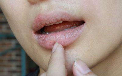 Suha usta (kserostomija) – uzrok, simptomi i liječenje