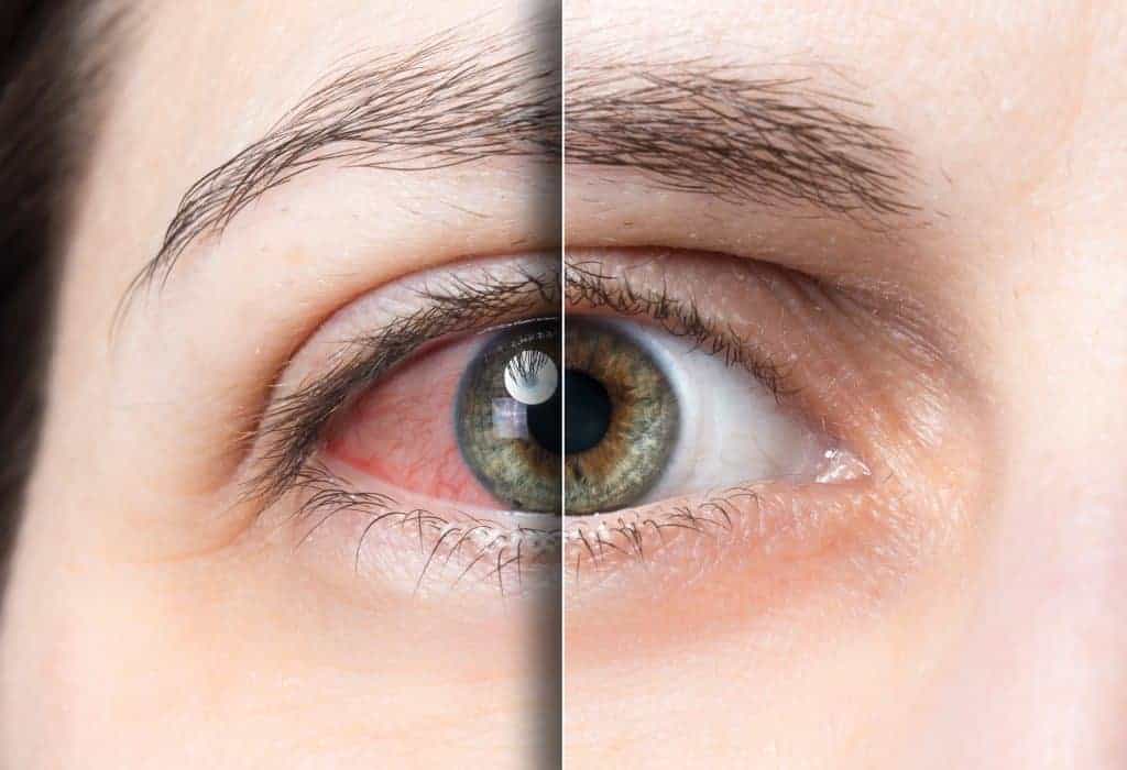 Umor očiju - kako ublažiti simptome