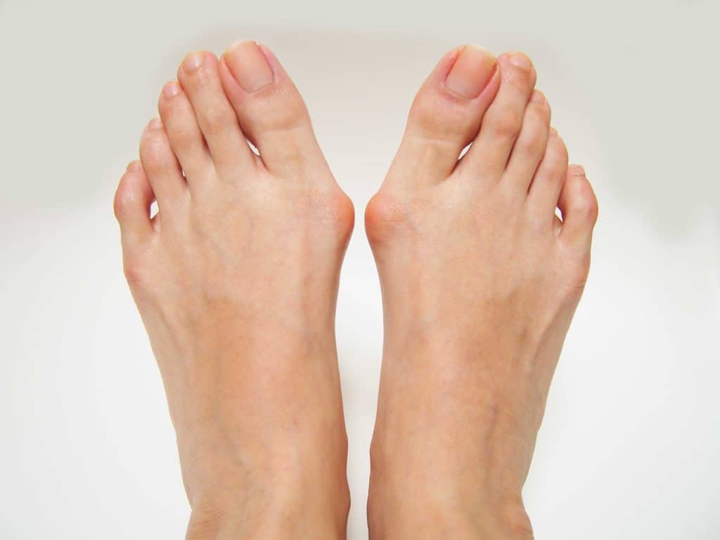 Valgus stopala - uzrok, simptomi, liječenje