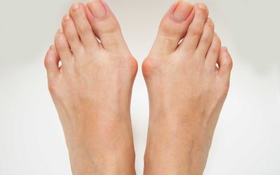 Valgus stopala – uzrok, simptomi, liječenje