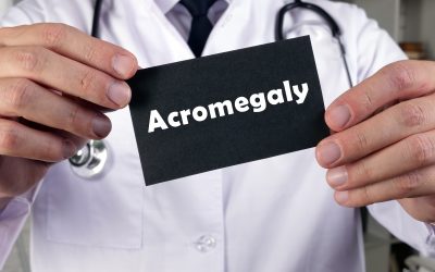 Akromegalija – uzrok, simptomi, liječenje
