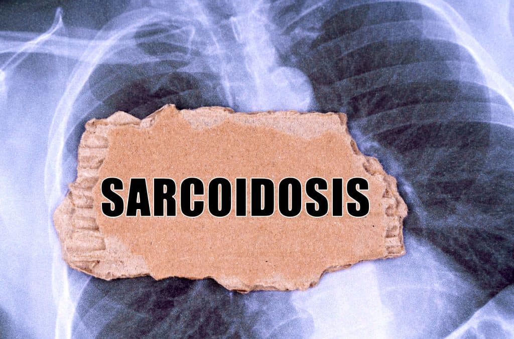 Sarkoidoza - uzrok, simptomi, liječenje