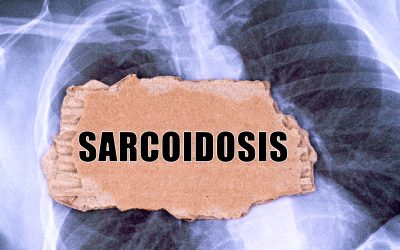 Sarkoidoza – uzrok, simptomi, liječenje