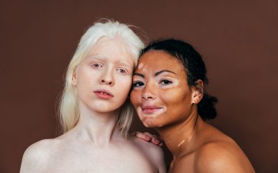 Albinizam – uzrok, simptomi, liječenje