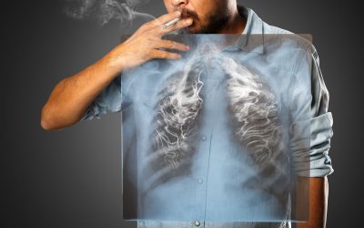 Karcinom pluća – uzrok, simptomi, liječenje